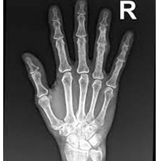X-ray Left Ring Finger